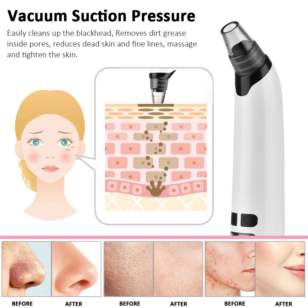 Facial Blackhead Remover Pore Cleaner Heat Function Nose T Zone Face Deep Acne Pimple Removal Face Household SPA Skincare Tools