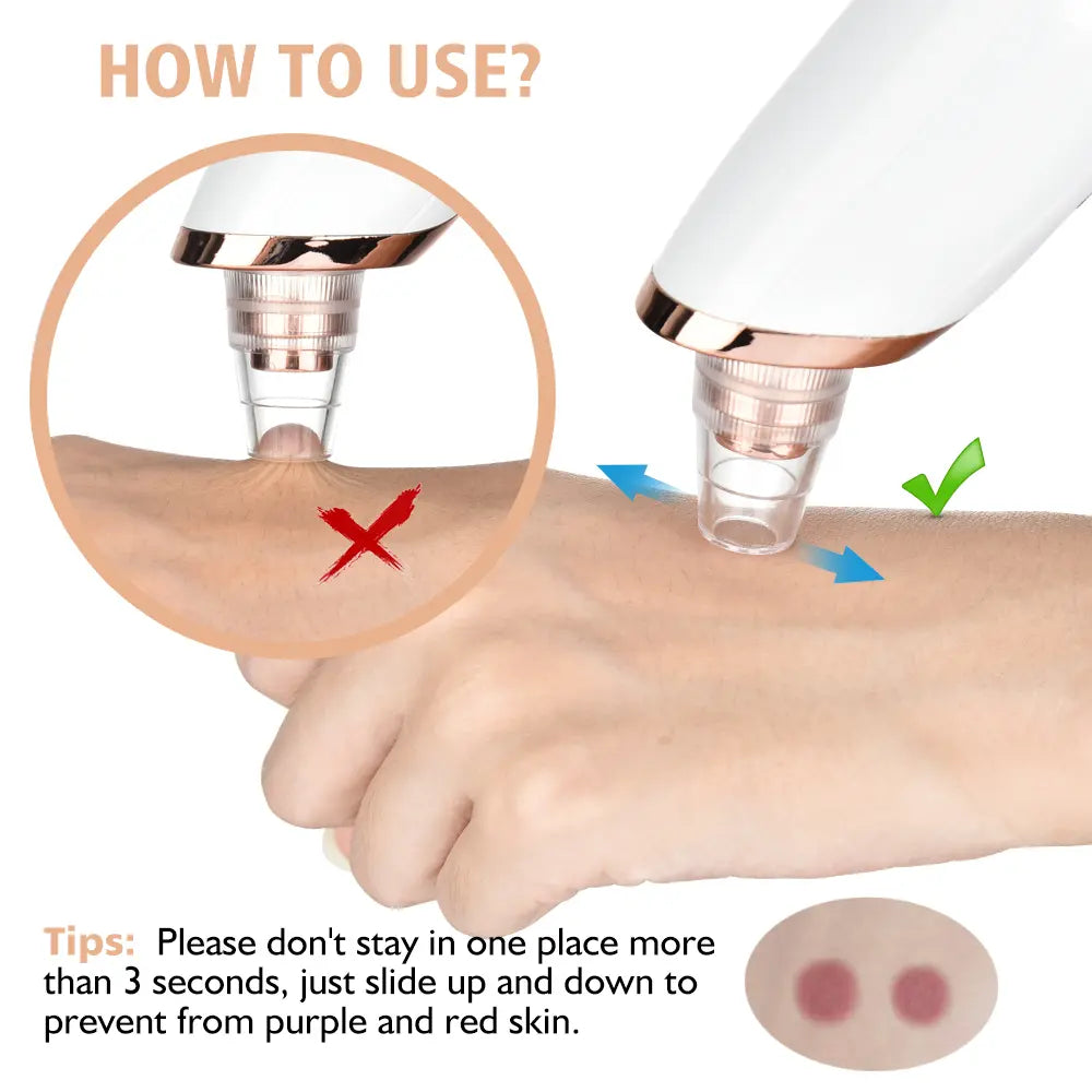 2026 Newest Facial Blackhead Remover Pore Vacuum - USB Rechargeable with Rechargeable Battery, 4 Replacement Tips, Heat Compression - Extractor Tool Set Skin Care Devices for Effective Blackhead Removal,Back to School,Back to School Haul